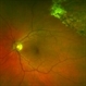 Retinoschisi and Retinal Detachment Retinoschisi and Retinal Detachment